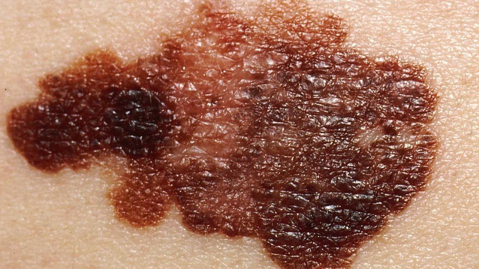 melanoma